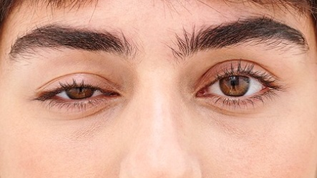 نمونه‌های درمان پتوز پلک و بلفاروپلاستی